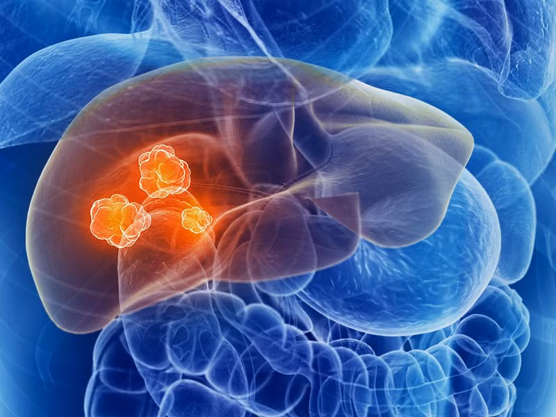 Trong những năm gần đây, số lượng bệnh nhân ung thư gan không ngừng tăng lên. Như câu nói, "bệnh từ miệng mà ra", ung thư không phải là chuyện có thể xảy ra đột ngột mà hoàn toàn không thể tách rời khỏi chế độ ăn uống hàng ngày của chúng ta. (Ảnh minh họa)