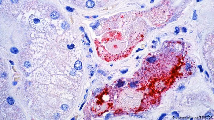 Người nhiễm virus Nipah thường có các triệu chứng như: sốt và đau đầu trong khoảng từ 3 ngày đến 2 tuần. Sau đó, bệnh nhân có thể bị ho, đau họng và gặp các vấn đề về hô hấp.