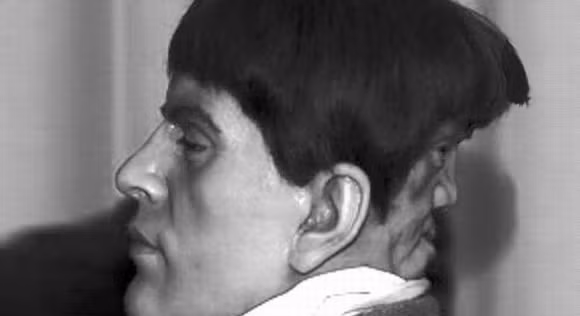 Edward Mordrake được sinh ra với một khuôn mặt thứ 2 gắn vào phía sau của đầu. Gương mặt này không thể nói nhưng có thể cười và khóc một cách riêng biệt từ những cảm xúc của Edward. Edward gọi đây là khuôn mặt "ma quỷ sinh đôi". Edward đã tự sát ở tuổi 23 sau khi bác sĩ từ chối loại bỏ nó từ hộp sọ của ông.