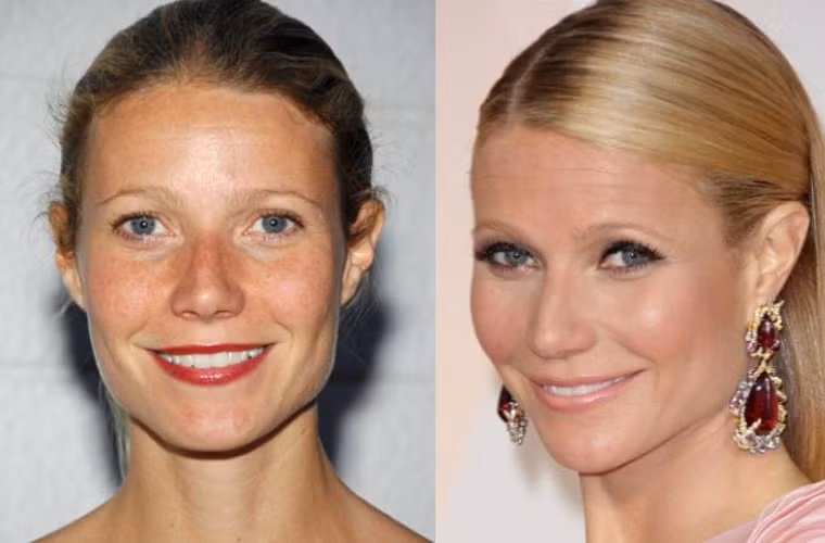 Gwyneth Paltrow cũng thừa nhận cô đã từng thử tiêm Botox và sau đó cô cảm thấy mình trẻ hơn tới 5 tuổi. Nhưng sau lần đó ngôi sao Hollywood đã không muốn lặp lại quy trình làm đẹp này nữa cho tới khi chạm ngưỡng 50. Trong ảnh là gương mặt Gwyneth năm 2007 và 2015 (phải).