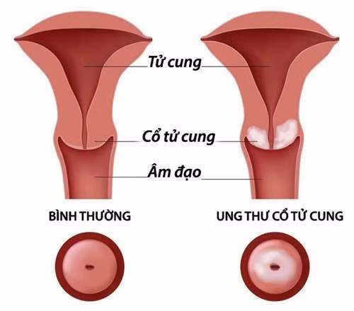 Xét nghiệm ung thư cổ tử cung là một xét nghiệm quan trọng phụ nữ nên làm ít nhất một lần trong đời. Mặc dù vậy các bác sỹ khuyến cáo nên khám sàng lọc ung thư mỗi ba hoặc năm năm một lần.