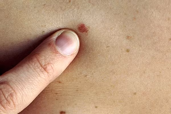 Riêng với ung thư da, thời điểm tốt nhất để kiểm tra là sau khi tắm. Biểu hiện của bệnh có thể là những vết loét dai dẳng, thỉnh thoảng tứa máu. Đôi khi nổi cục song cũng có thể hình thành lớp sừng hóa.
