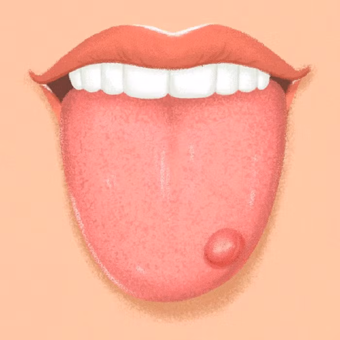 Lưỡi có đốm đỏ và mụn nước. Các đốm đỏ và mụn nước trên lưỡi rất dễ bị nhầm lẫn với một chứng bệnh thông thường, đó là nhiệt miệng. Tuy nhiên, nếu các đốm đỏ và mụn này không tự biến mất mà tồn tại trong thời gian dài thì bạn nên đi khám bác sĩ ngay bởi đó là dấu hiệu của căn bệnh ung thư lưỡi.
