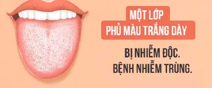 Lưỡi phủ lớp niêm mạc trắng dày. Lớp phủ niêm mạc này thường bắt nguồn từ các vấn đề dạ dày như nhiễm độc hoặc đang ăn kiêng quá mức. Bạn có thể xử lý chúng bằng cách sử dụng bàn chải đánh răng để gạt đi, điều chỉnh chế độ ăn hàng ngày.