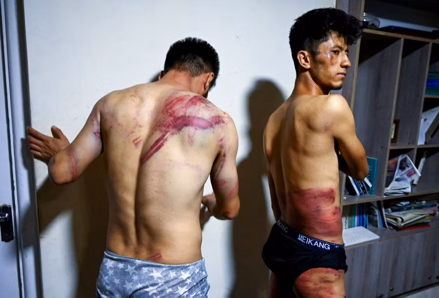 Nematullah Naqdi (trái) và Taqi Daryabi, các nhà báo của tờ báo Etilaatroz - Afghanistan với cơ thể chẳng chịt vết thương. Họ đã bị các chiến binh Taliban đánh đập và giam giữ trong nhiều giờ vì đưa tin về một cuộc biểu tình ở thủ đô Afghanistan.