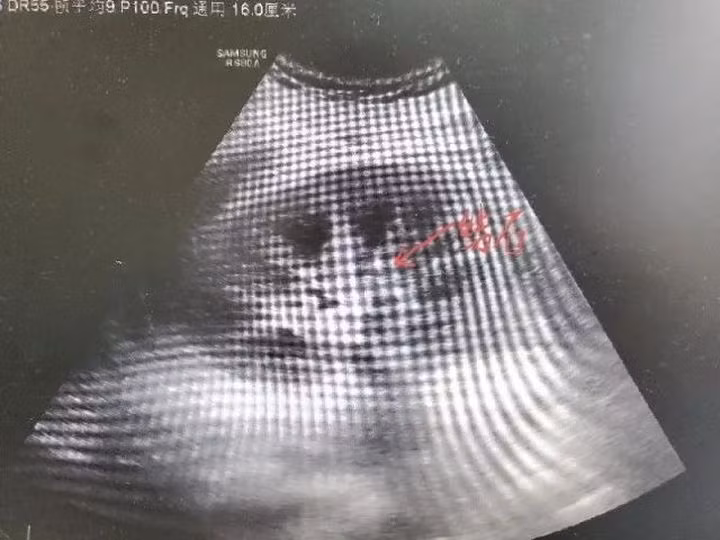 Chàng trai 18 tuổi phải chạy thận vì mỗi ngày đều uống thứ này - Hình 2 Chang trai 18 tuoi phai chay than vi moi ngay deu uong thu nay-Hinh-2