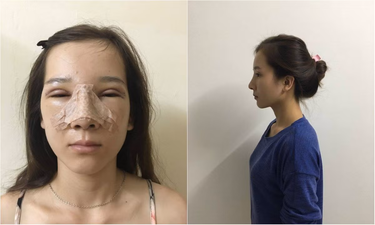Chính ngoại hình ấy khiến nữ sinh Y khoa - ĐH Y khoa Vinh phải buồn tủi, khổ sở khi bị gia đình nhà người yêu cấm cản, bị bạn bè chê bai và không thể kiếm được việc làm chỉ với lý do "ánh mắt ti hí không trung thực".