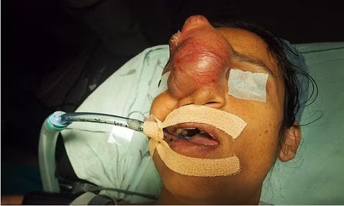 Lan dau duoc hon chong nho phau thuat cat khoi u tren mat