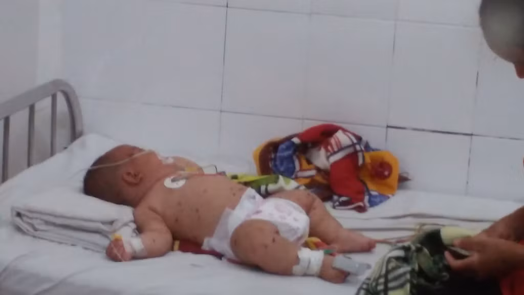 Phat hien benh nhi nghi nhiem viem mang nao mo cau o Dak Lak