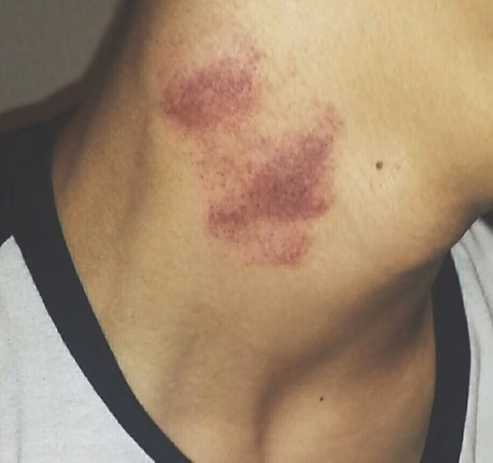 Những dấu hôn được gọi là hickey hay "ấn dâu tây", là một trong những cách thể hiện tình yêu cuồng nhiệt của một số bạn trẻ.