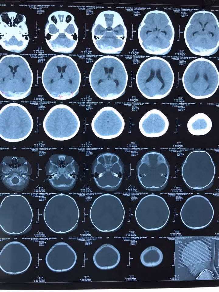 Phim CT-scan trước phẫu thuật cho thấy bệnh nhi có máu tụ ngoài màng cứng chẩm hai bên Phim CT-scan trước phẫu thuật cho thấy bệnh nhi có máu tụ ngoài màng cứng chẩm hai bên