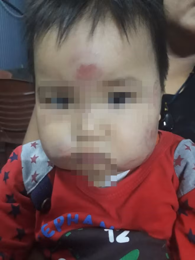 Cụ thể trên trang cá nhân của mình, nickname T.M.H đã chia sẻ những hình ảnh con trai mình sau khi đi nhà trẻ về thì xuất hiện những vết bầm tím phần mặt cho tới các bộ phận trên cơ thể như chân, tay. Cụ thể, lần đầu tiên chị H phát hiện những vết bầm tím trên người con vào ngày 19/10.