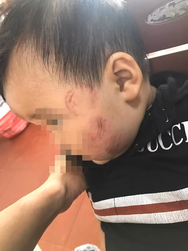 Nickname Minh Huế chia sẻ: "Nhìn con mà xót thế. Mình cũng trong giai đoạn có con đi mẫu giáo mà nhìn vào đây mà mất hết niềm tin để giao con cho các cô. Cần lắm các cơ quan chức năng vào cuộc để làm sáng tỏ sự vụ".