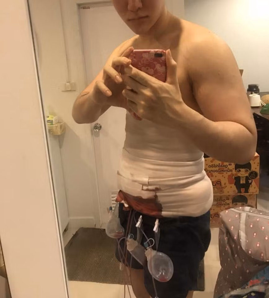 Để thực hiện được cách phẫu thuật body 6 múi này, bác sĩ sẽ tiến hành hút mỡ bụng bệnh nhân để các múi cơ lộ ra. Sau đó, họ tiếp tục được tách tế bào mỡ từ các rãnh giữa khối cơ, kết hợp tia laser để cầm máu bệnh nhân. Quá trình tạc cơ bụng này kéo dài từ 1-2 giờ đồng hồ.