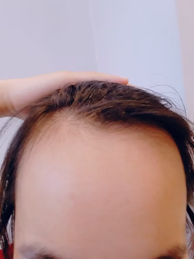 Mới đây, hội chị em MXH đã có dịp khoe vầng trán cao của mình sau khi một thành viên chia sẻ bức ảnh của mình cùng dòng tâm sự: "Giỏi giang, lợi lộc ở đâu không biết nhưng nỗi khổ tâm lớn nhất đó là làm sao để nuôi tóc che bớt cái "trán sân bay"".