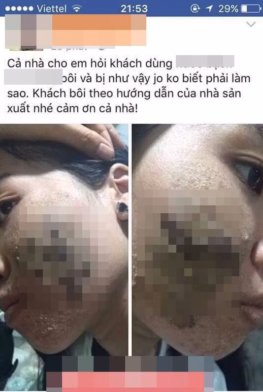Chiều 16/1, trong một nhóm quy tụ nhiều thành viên là nữ giới, một nickname có tên H.O có đăng tải bức hình về một cô gái sau khi sử dụng mỹ phẩm dưỡng da không rõ nguồn gốc: Gương mặt nổi mẩn, sần sùi, da bị bong tróc của cô khiến nhiều người hoảng hốt và thấy hơi ghê sợ.