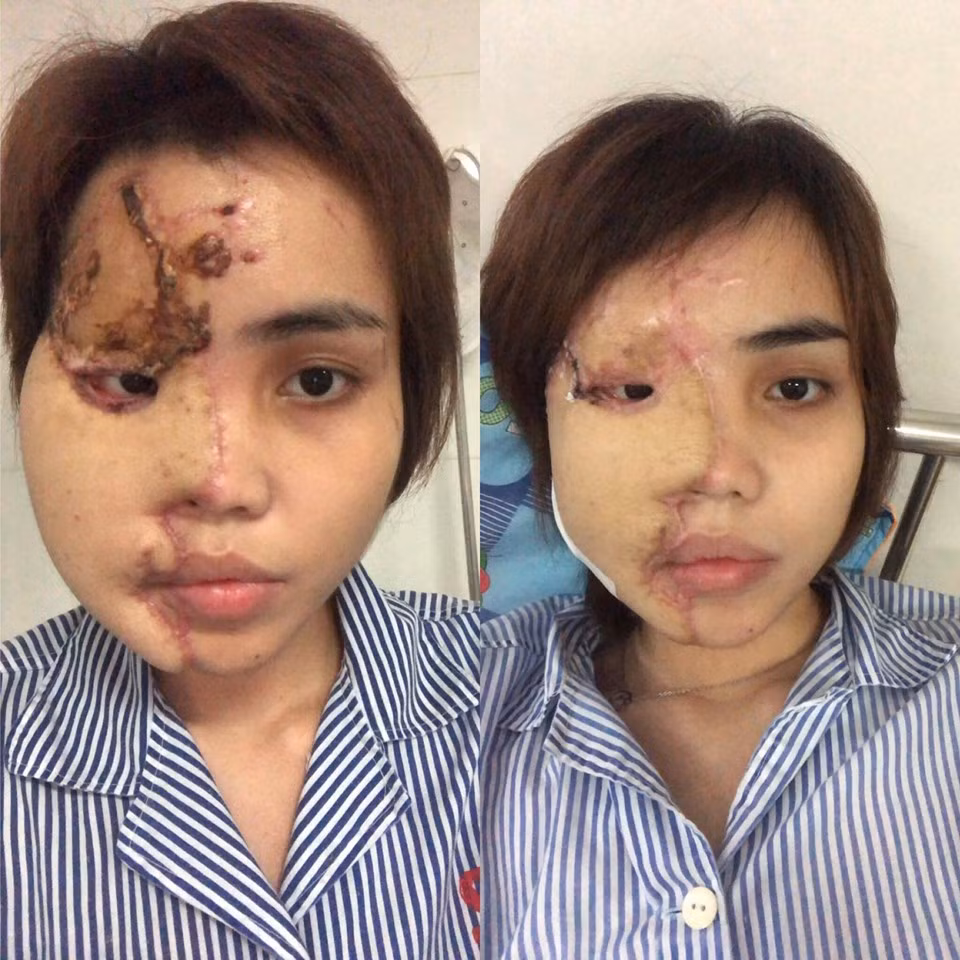 Từ một cô gái trẻ trung, xinh đẹp, gương mặt của Lê Thị Lan Vy, 24 tuổi ở Đà Nẵng đã bị hủy hoại sau khi bị chồng sắp cưới là thiếu úy PCCC Nguyễn Trương Nam Hải tạt axit vào đúng ngày 1/1/2019.