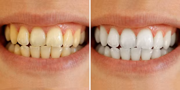 Cao răng lâu năm đến mấy cũng bong ra từng mảng Cao rang lau nam den may cung bong ra tung mang