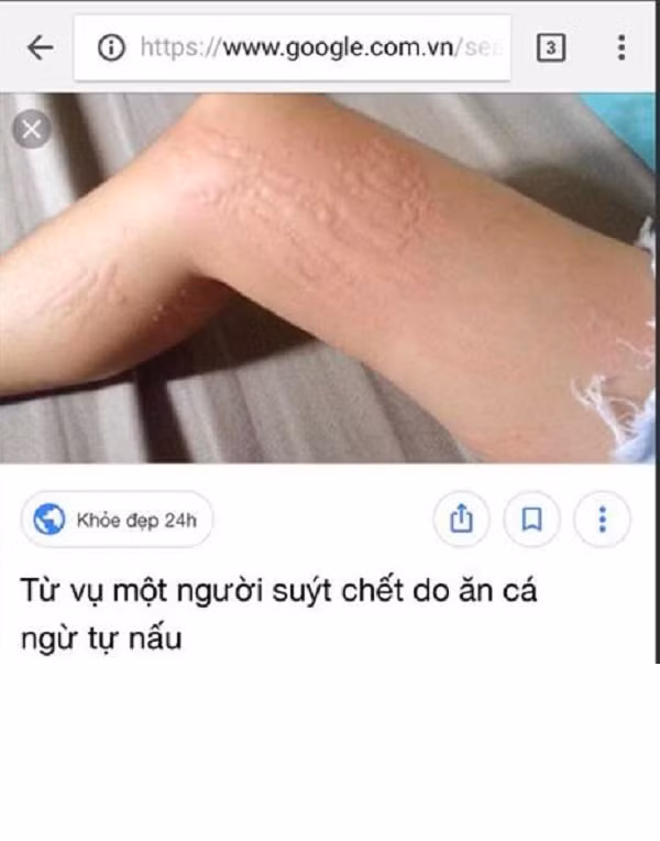 Hot girl scandal Thúy Vi, vừa bị hàng loạt khách hàng lên tiếng tố bán kem tắm trắng kém chất lượng làm hại da người sử dụng, khiến dư luận không khỏi xôn xao. Cụ thể, một tài khoản Facebook có tên D. đã đăng tải lên mạng xã hội hình ảnh tay và chân bị nổi mề đay sau khi sử dụng sản phẩm mua từ hãng kem của cô gái Cà Mau.