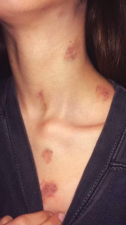 Trên thế giới, không ít những ca tử vong sau khi cùng người yêu kiểu hickey. Nguyên nhân được cho là một cục máu đông từ vết cắn đã di chuyển lên não, làm vỡ mạch máu não.