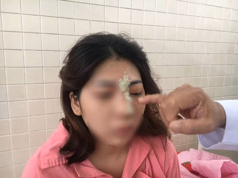 Co gai 21 tuoi mu mat sau khi tiem filler nang mui