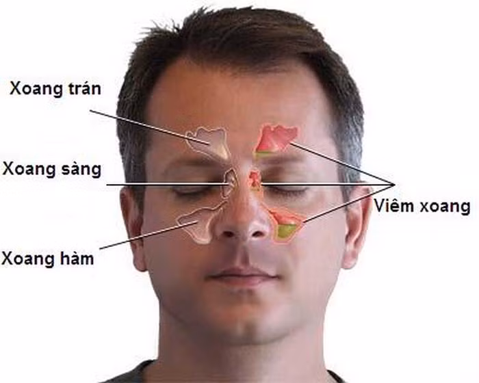 Viêm xoang là một bệnh xảy ra do viêm các xoang cạnh mũi. Nguyên nhân gây bệnh có thể do môi trường chứa nhiều vi khuẩn, vi khuẩn vào mũi gây viêm. Bệnh xoang không phải là vấn đề sức khỏe nghiêm trọng nhưng nó làm người bệnh sinh hoạt khó khăn, nhất là vào mùa lạnh. Các bạn có thể áp dụng các bài thuốc chữa viêm xoang từ các loại hạt sau. Ảnh: Bepmonngon.
