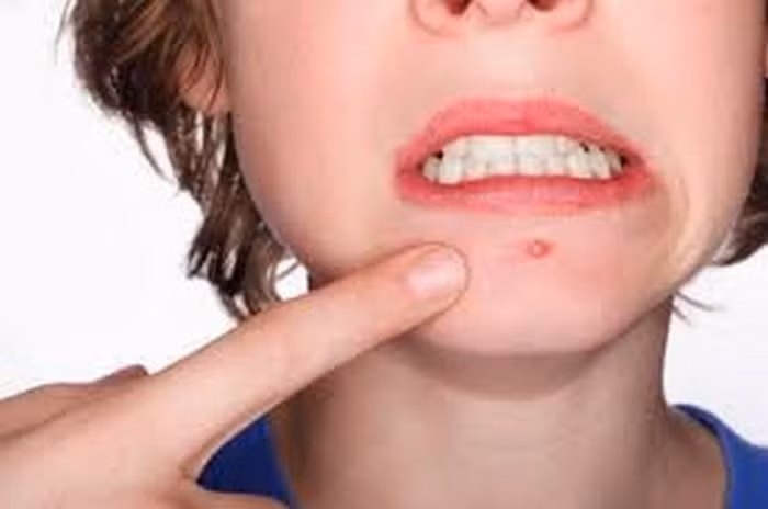 Muội vàng dùng để giảm sưng, giảm đau khớp, làm cứng khớp. Nhưng đó là quá trình điều trị chậm, bệnh nhân thường mất tới 22 tuần tiêm vàng mới khỏi bệnh. Ảnh: Suaongchua.