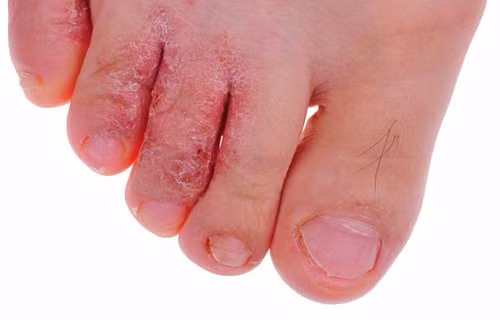 Nấm ăn chân, ghẻ: Lấy lá đào tươi giã nát, đắp. Ảnh: benhmedaymanngua.com.
