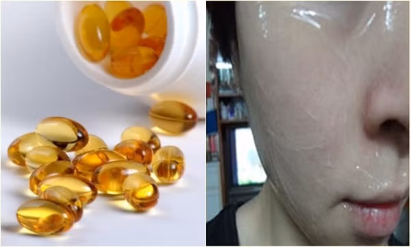 Có thể dùng viên nang vitamin E bôi trực tiếp lên da mặt cũng rất tốt, những vết thâm sẹo do mụn để lại cũng nhanh chóng biến mất. Thực hiện đều đặn 1 - 2 tháng. Ảnh: trivettham.net.