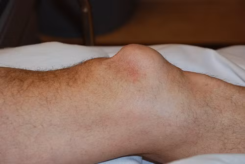 2. Trị chứng đau nhức, sưng đầu gối: Lá dâu da xoan tươi 30g, rửa sạch giã nát, trộn với giấm hay rượu đắp lên nơi đau, sưng. Ngày đắp hai lần vào sáng và tối trước khi đi ngủ, mỗi lần đắp khoảng 30 phút. Ảnh: benhcoxuongkhop.net.