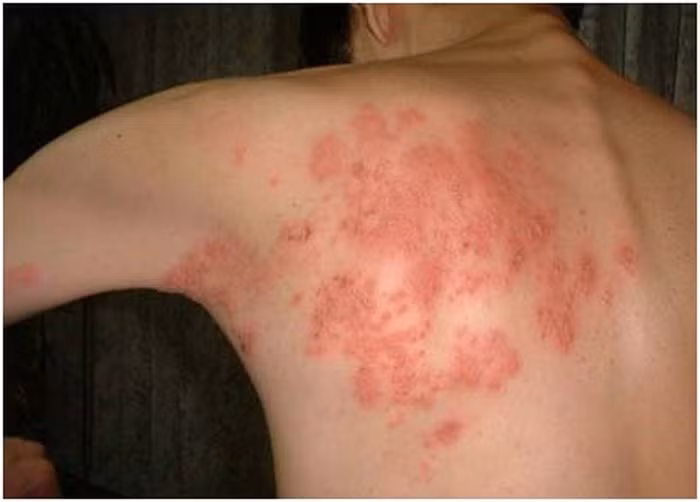 Chàm Eczema là một loại bệnh dị ứng. Nó biểu hiện trên da là những vùng đỏ ửng, ngứa rát, nặng thì bong tróc vảy. Bệnh không nguy hiểm tính mạng nhưng lại gây bất tiện trong sinh hoạt. Người bệnh có thể chữa bệnh chàm Eczema từ củ quả sau. Ảnh: Benhvirus.