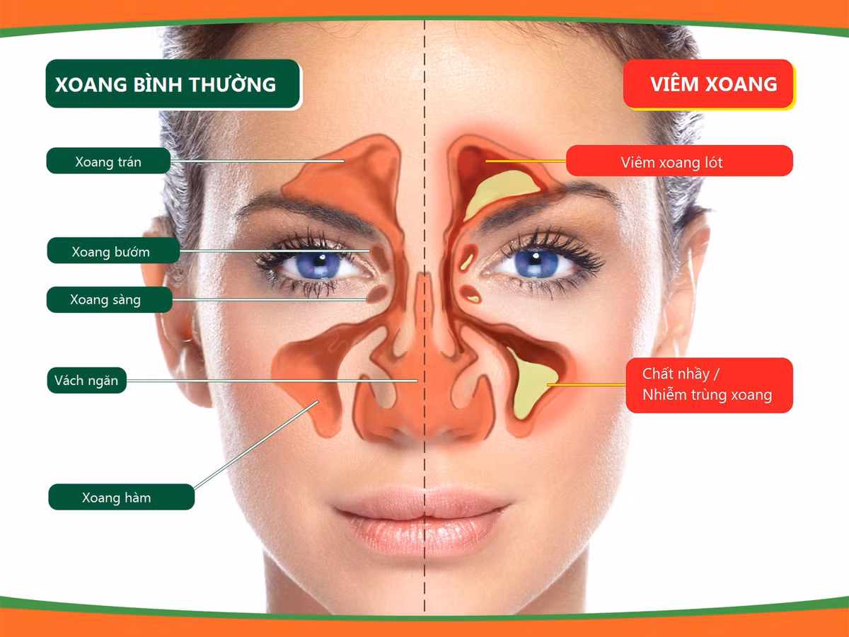 Ngày nay, không chỉ bảo vệ con người tránh khỏi bụi bẩn, ô nhiễm... chiếc khẩu trang còn có tác dụng trị bệnh, bệnh điển hình mà rất nhiều người áp dụng thành công đó bệnh viêm xoang, viêm mũi dị ứng, dù nặng tới mấy cũng vẫn khỏi. Ảnh: bacsiviemmuiviemxoang.com.
