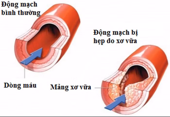 Chữa bệnh cao huyết áp, xơ vữa động mạch. Dùng 5-10ml giấm gạo, 10 hạt lạc nhân và ngâm lạc trong giấm từ buổi tối. Sáng hôm sau ăn cả nước và cái, liên tục trong 10-15 ngày. Ảnh: Cholestin.