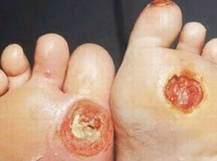 Chữa sốt kéo dài sau nhiễm trùng: Trong thời kỳ hồi phục vẫn còn sốt, nhiệt độ không cao nhưng kéo dài, miệng khô, khát nước. Thạch cao 30g, lá tre 12g, mạch môn đông 20g, nhân sâm 6g, bán hạ 6g, cam thảo 4g, gạo tẻ 30g; sắc lấy nước, chia 3 lần uống trong ngày. Ảnh: Infonet.