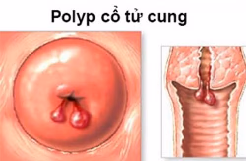 Chảy máu tử cung: Dùng phối hợp đương quy với a giao, ngải diệp và sinh địa hoàng. Ảnh: triviemcotucung.com.