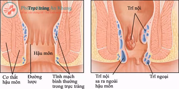 1. Chữa trĩ: Ốc đồng sống 1 con, băng phiến. Gỡ yếm ốc ra, rồi đặt băng phiến vào miệng ốc. Một lúc thì miệng ốc tiết nước ra lấy nước đó bôi vào trĩ. Ảnh: phongkhamankhang.vn.