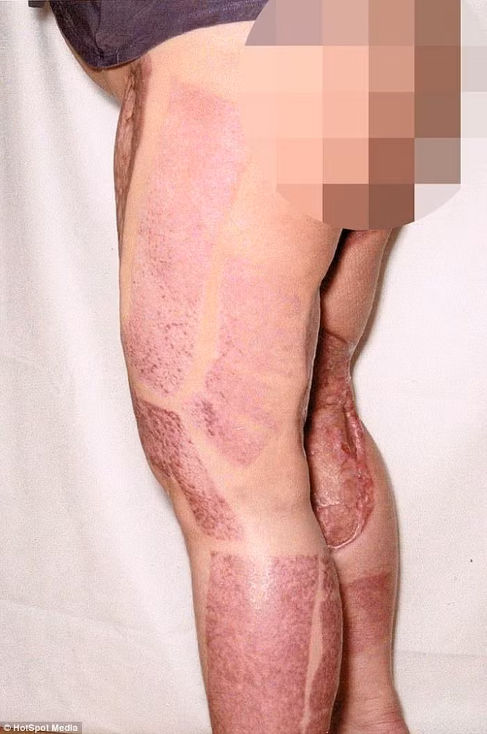 Sau đó, Dana trải qua cuộc phẫu thuật kéo dài 10 giờ đồng hồ để chữa lành và cấy ghép vùng da hoại tử. Tuy nhiên, các bác sỹ cảnh báo có thể sau này cô sẽ không đi lại được như người bình thường.