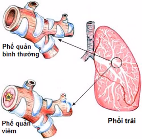 Mẹo phân biệt hen phế quản và tắc nghẽn phổi mãn tính Meo phan biet hen phe quan va tac nghen phoi man tinh