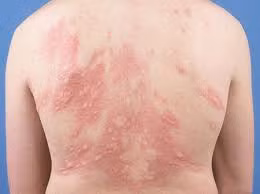 4. Trị mề đay: Mỗi ngày dùng tàm sa 60g, sắc nước chia 2 lần sáng tối uống. Ngoài ra dùng 120g sắc để xông rửa vùng bệnh 20 phút, mỗi ngày 2 lần. Ảnh: anlieu.com. (Thông tin trong bài chỉ mang tính chất tham khảo, trước khi sử dụng bài thuốc, vui lòng hỏi ý kiến bác sĩ).
