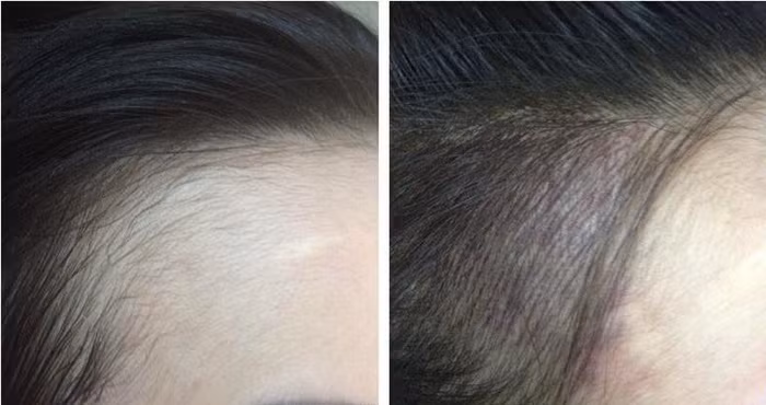 Phần tóc phun thêu sẽ giữ được khoảng 2 năm giống như điêu khắc chân mày.