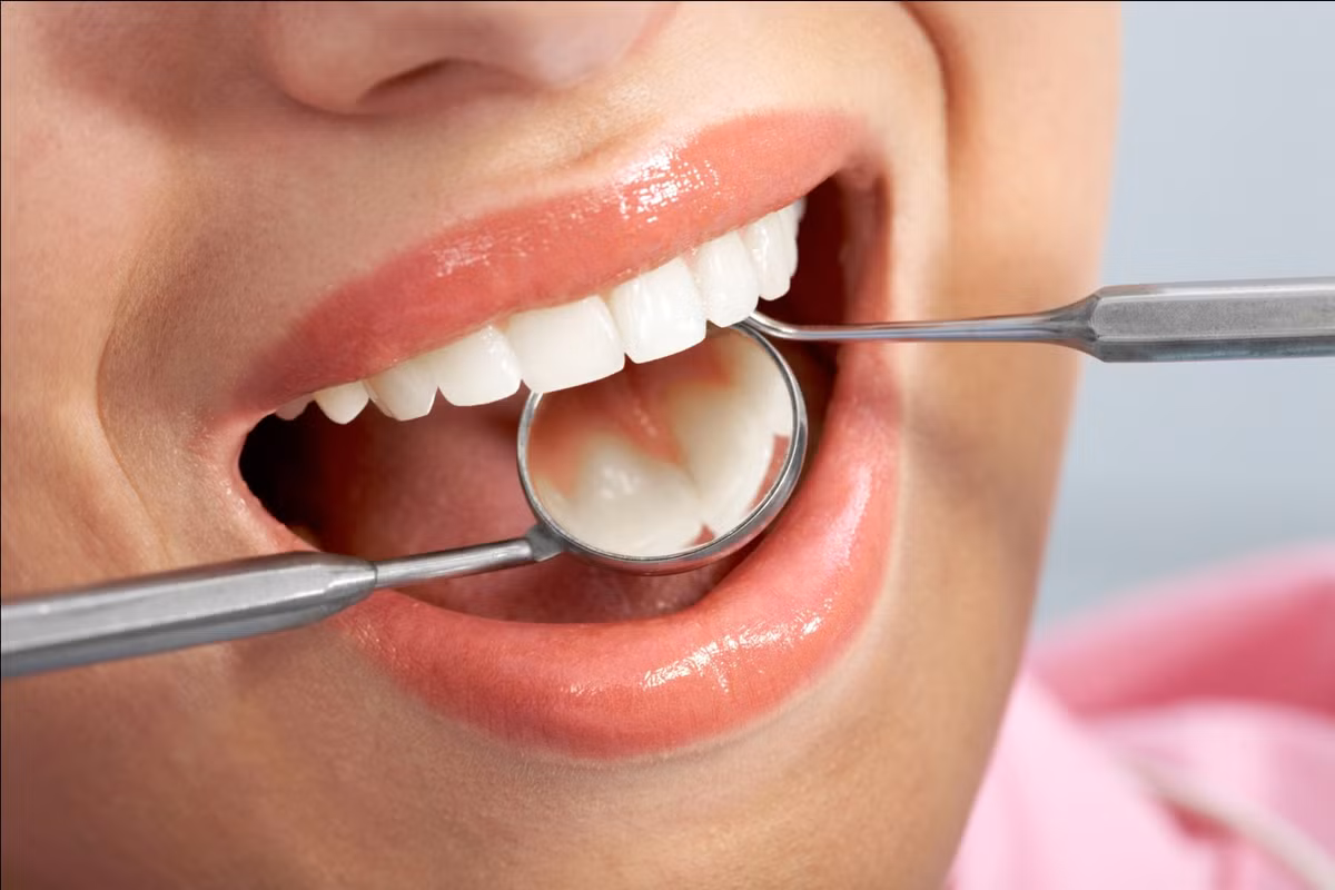 7. Chữa sâu răng: Dùng cành liễu nấu cao xỉa. Ảnh: koreadental.vn. (Thông tin trong bài chỉ mang tính tham khảo, trước khi sử dụng bài thuốc, bạn vui lòng hỏi ý kiến bác sĩ).