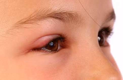 Mắt đau sưng đỏ: Bồ công anh 40g, Dành dành 12g. Sắc uống ngày một thang. Ảnh: bammimat.net.