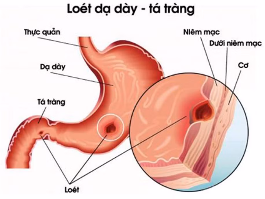 Viêm loét dạ dày, tá tràng: Bồ công anh 40g, lá Khôi, Nghệ vàng 20g, Mai mực 10g, Cam thảo 5g. Sắc uống ngày một thang. Ảnh: bacsydaday.com.