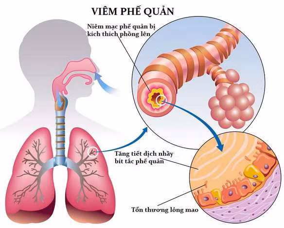 6. Chữa viêm phế quản, lao hạch, lao phổi: Theo tài liệu nước ngoài, có thể lấy hoa quỳnh 15-30g thái nhỏ, nấu với thịt lợn nạc làm món ăn. Ảnh: pqa.com.vn.