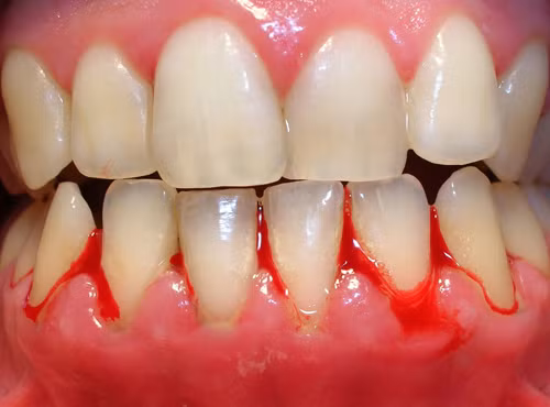 2. Chảy máu nướu răng: Lá phèn đen phơi khô, rửa sạch ngậm từ 7-10 phút, ngày 2 lần sau khi vệ sinh răng miệng sạch sẽ. Ngậm liên tục 5-7 ngày. Ảnh: nhakhoadangluu.com.vn.