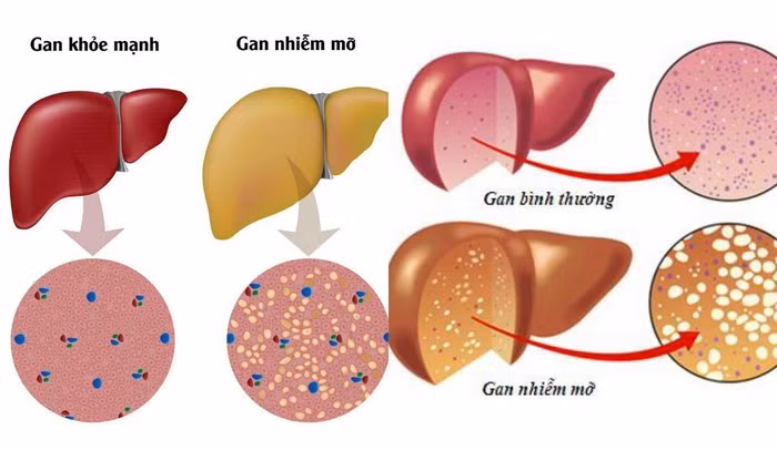 Gan nhiễm mỡ là căn bệnh bắt nguồn từ lối sống không lành mạnh, ăn uống không điều độ dễ dẫn đến gan nhiễm mỡ. Người bệnh nên đặt ra chế độ ăn uống hợp lý, hạn chế mỡ, chất cồn. Ngoài ra có thể chữa bệnh gan nhiễm mỡ bằng trà dược cũng có tác dụng rất tốt. Ảnh: Lasen. 