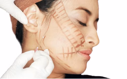 Phẫu thuật căng da mặt sẽ luôn để lại sẹo. Phẫu thuật căng da mặt sẽ luôn để lại sẹo.