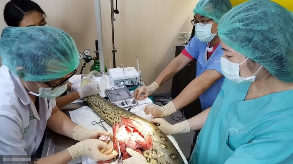 Trong ảnh là các bác sĩ đang phẫu thuật, bóc tách khối u. (Nguồn Sina)