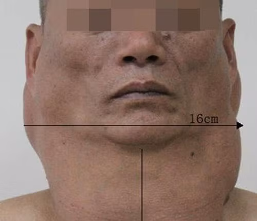 Cổ phình to như lạc đà vì uống rượu suốt 30 năm Co phinh to nhu lac da vi uong ruou suot 30 nam