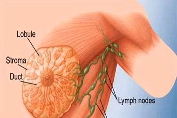 Ung thư vú. Ít hơn 3% ung thư vú là do lỗi gen di truyền. Những người bị ung thư vú thường có một tập hợp các gen đột biến, được gọi là gen BRCA. Những người có xét nghiệm ADN kết quả cho thấy rằng họ có nhiều khả năng phát triển ung thư vú thì nên tiến hành kiểm tra vú thường xuyên ngay từ khi còn trẻ.